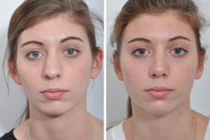 Rhinoplasty